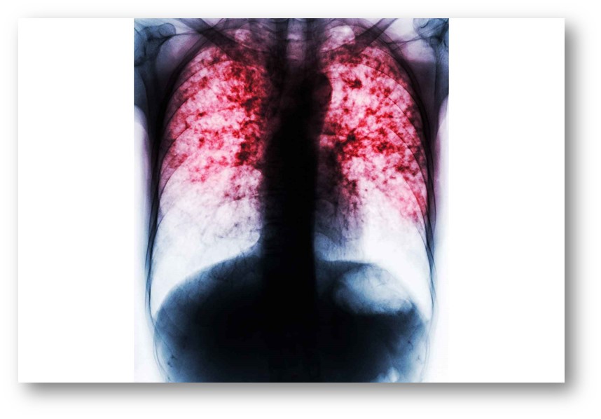 common respiratory diseases