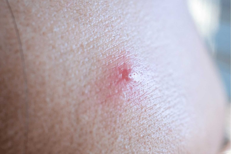 Inflammatory acne on skin