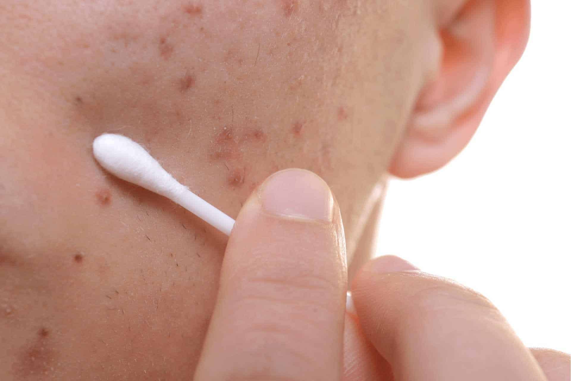 How to get rid of acne fast