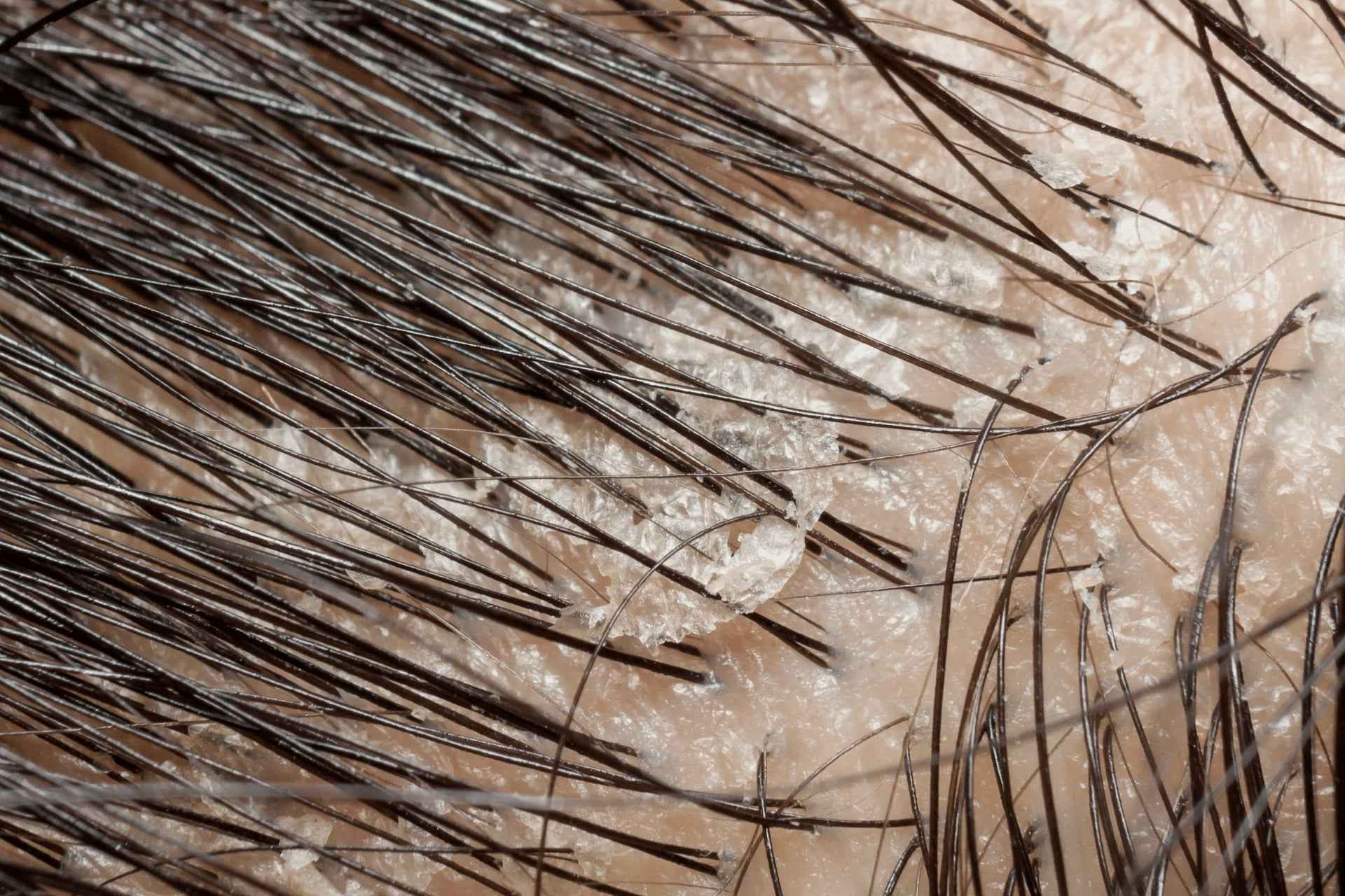 Best shampoo for natural hair with dandruff
