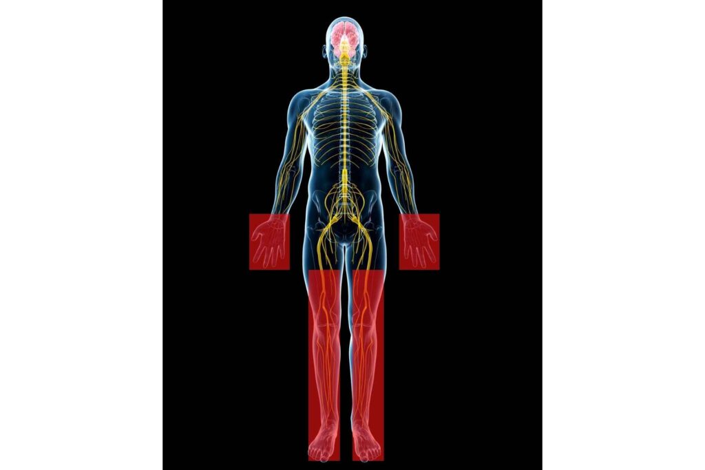 A human body sketch with Peripheral neuropathy