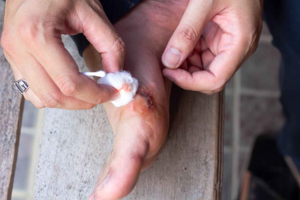 A man cleaning foot wound with cotton