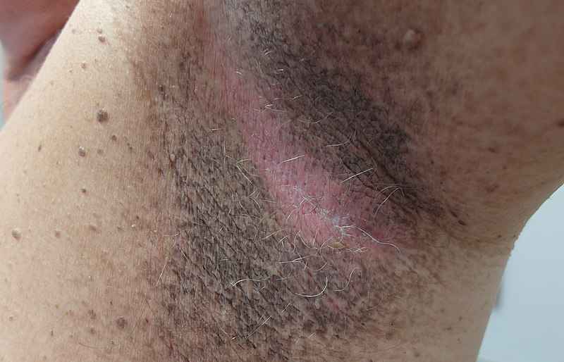 An armpit with Acanthosis nigricans