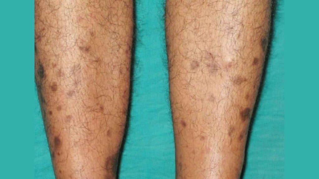 diabetic legs with Diabetic-dermopathy