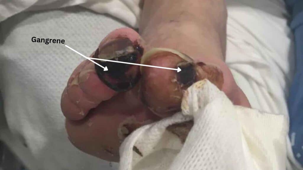 Gangrene on foot