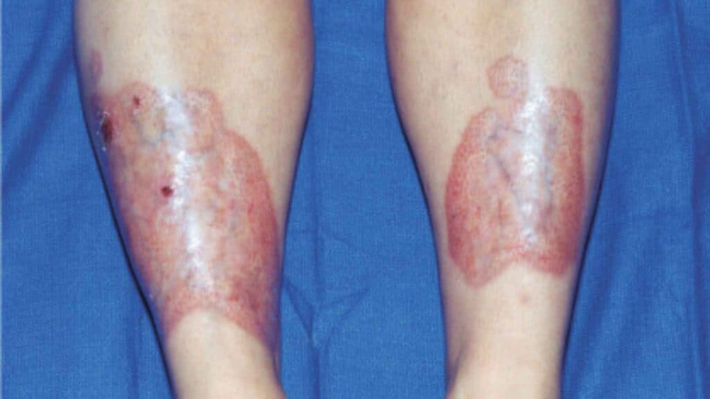 legs with Necrobiosis-lipoidica-diabeticorum