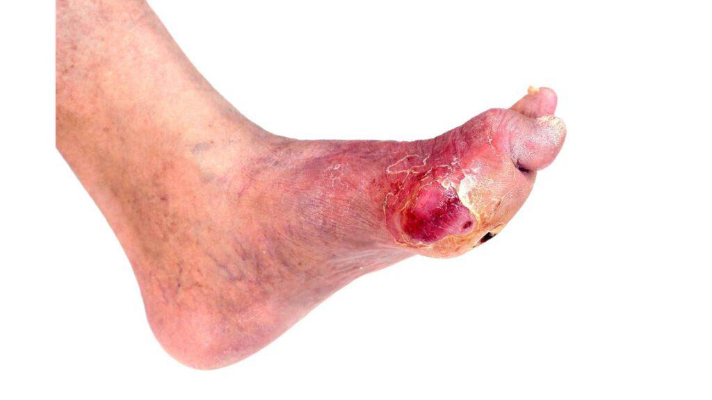 Diabetic Ulcer on foot