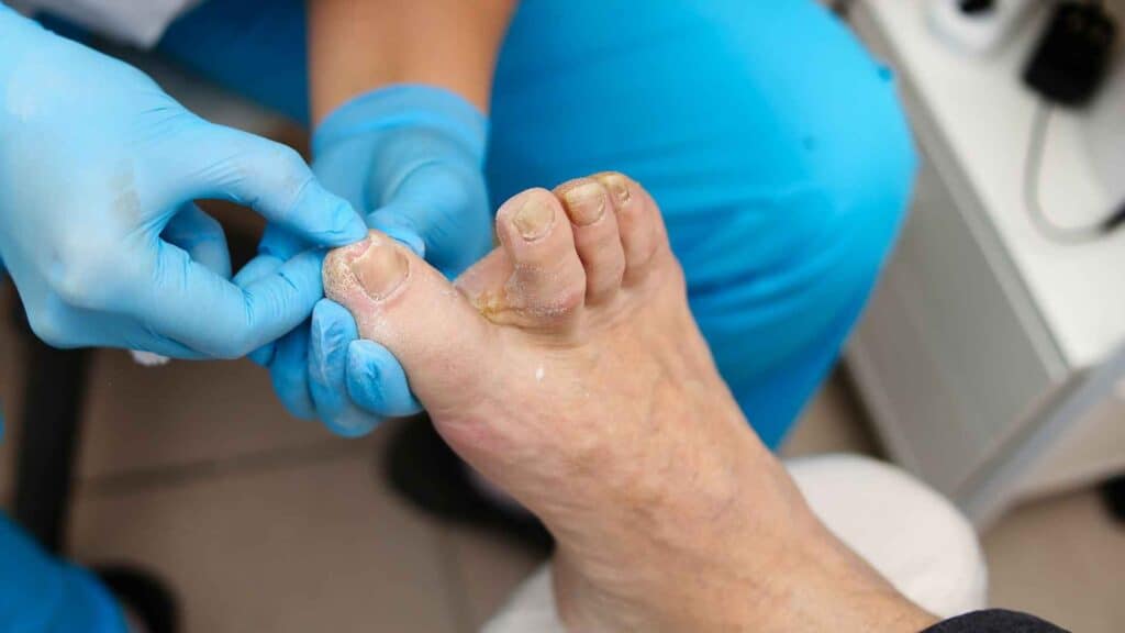 Diabetic thickened toenail cleaning by a nurse
