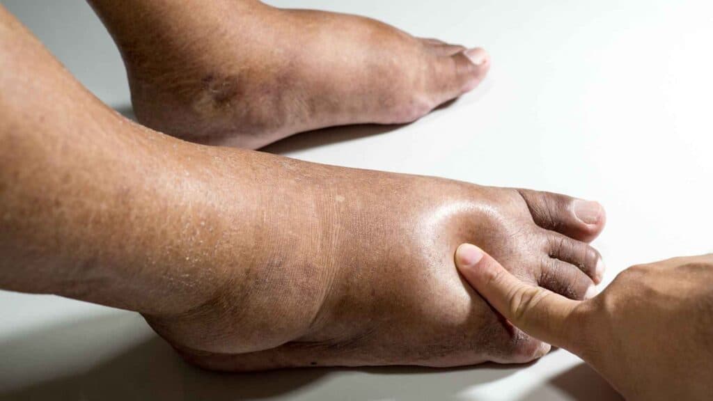 Diabetic swelled feet pressed by finger 