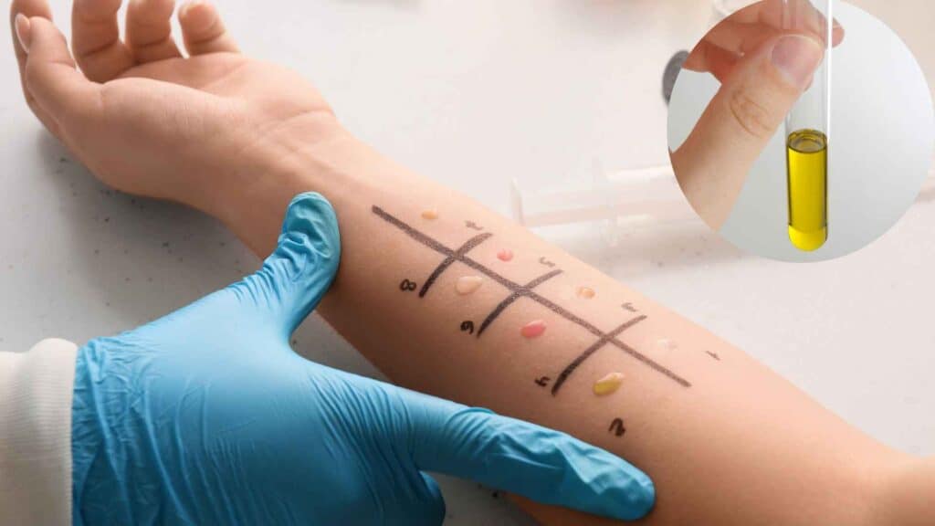 Arm skin marked with marker for Patch test