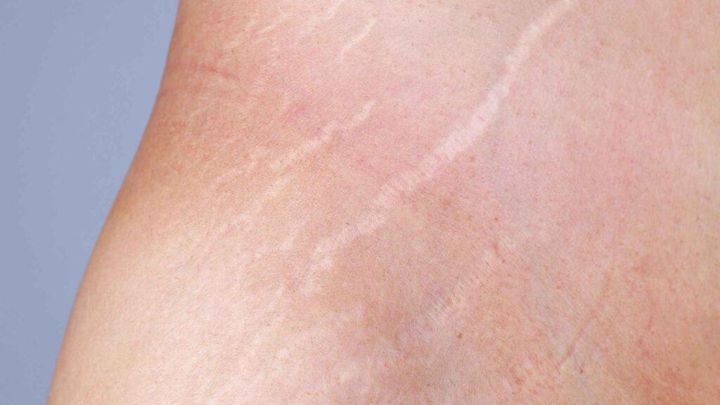Strech marks on skin