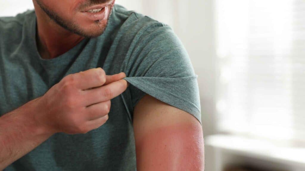 A man with sunburned arm