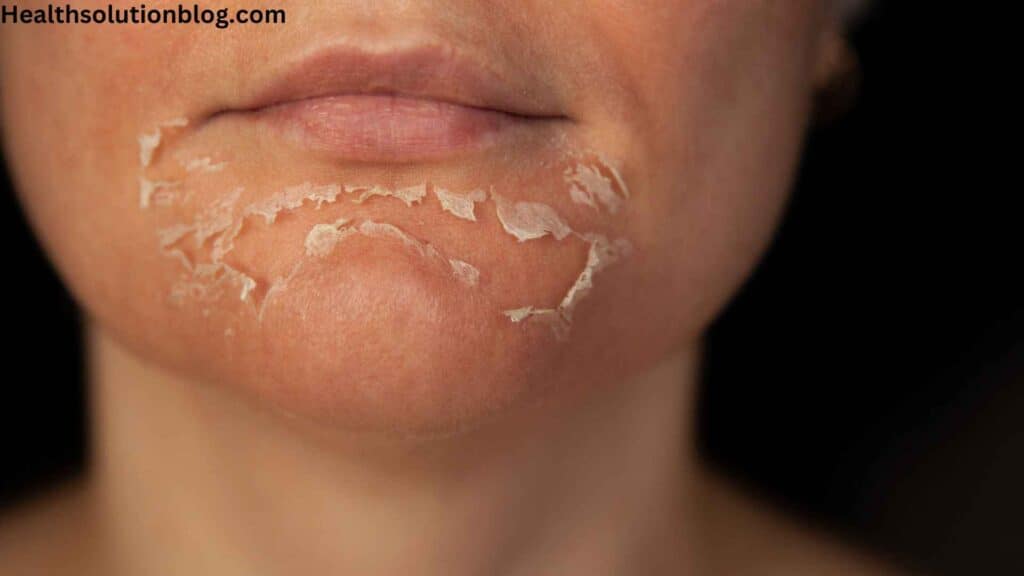 A woman peeled face with chemical exfoliator