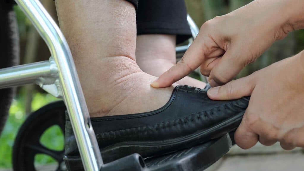 Pressing diabetic foot of wheeleed chair person