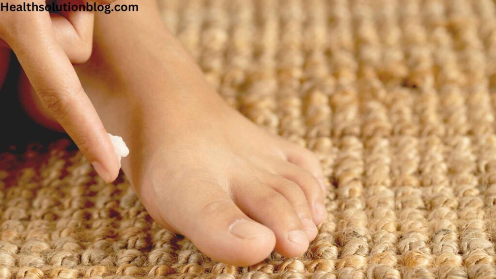 A person with antifungal cream on finger applying on foot