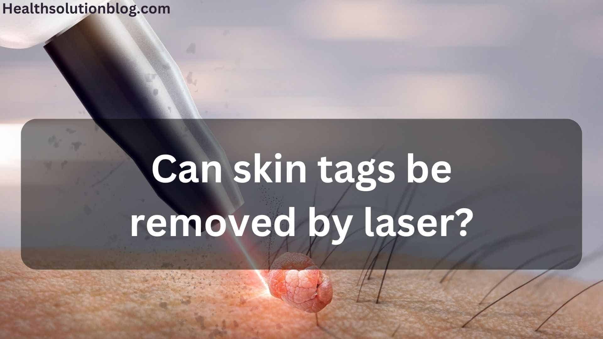 Can skin tags be removed by laser