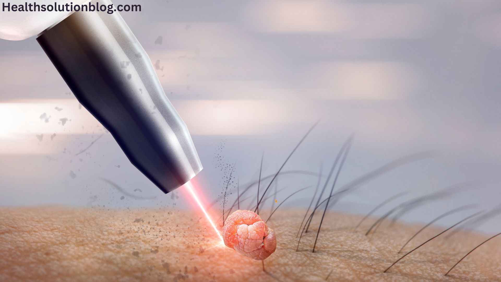 Can skin tags be removed by laser? Your Guide to a Smoother, TagFree