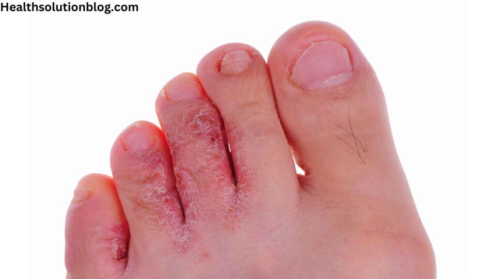 Athelet's foot of person, finger effected