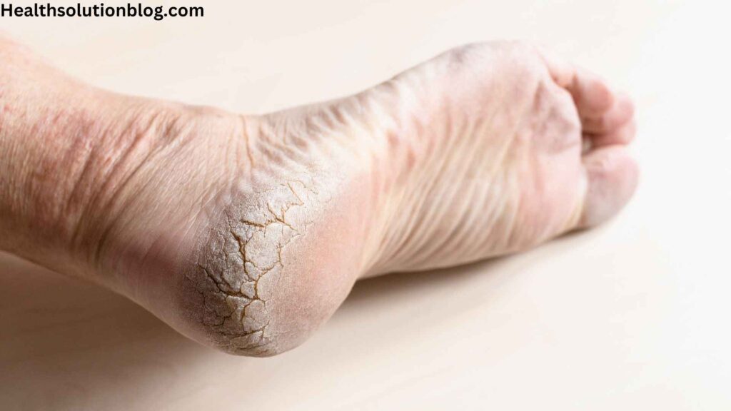 A cracked dry heel of a person