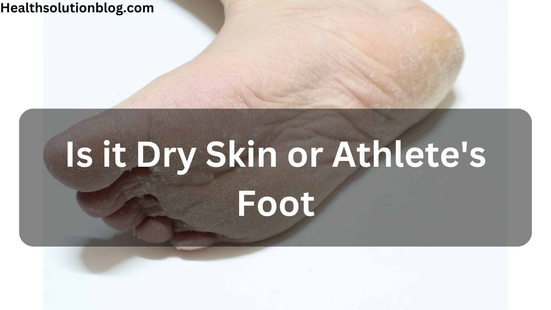 Is it Dry Skin or Athlete's Foot