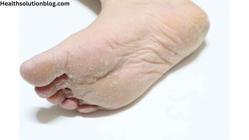 Is it Dry Skin or Athlete's Foot