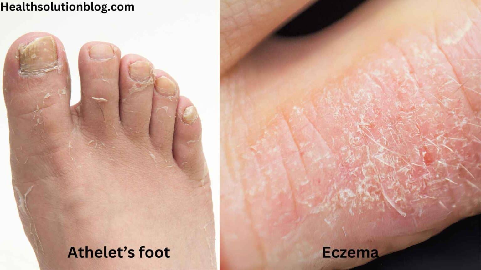 Athlete’s Foot vs Eczema: Navigating Causes, Symptoms, and Treatments ...