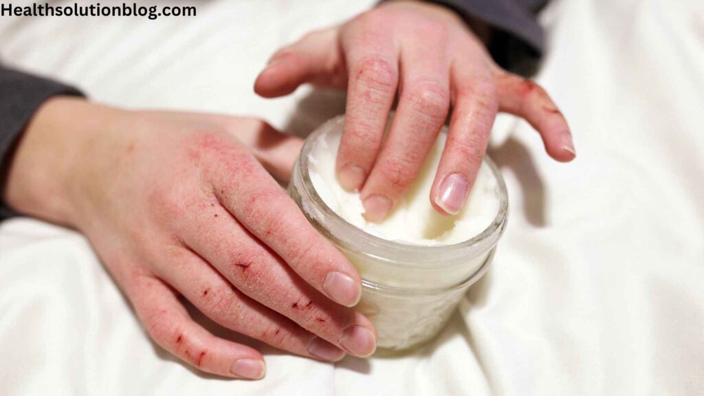 A child with cracked finger skin putting fingers in a jar of cream