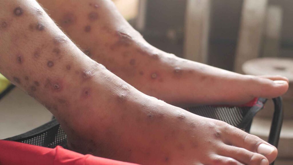 Feet with scabies red bumps