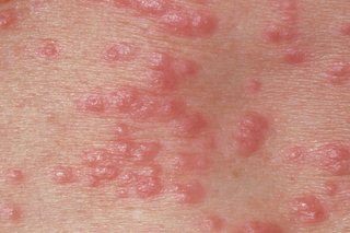 Red, Pimple-like bumps on skin