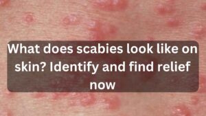 What does scabies look like on skin