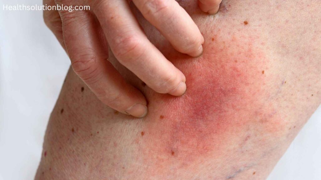 A person scratching red itched skin, Localized reaction