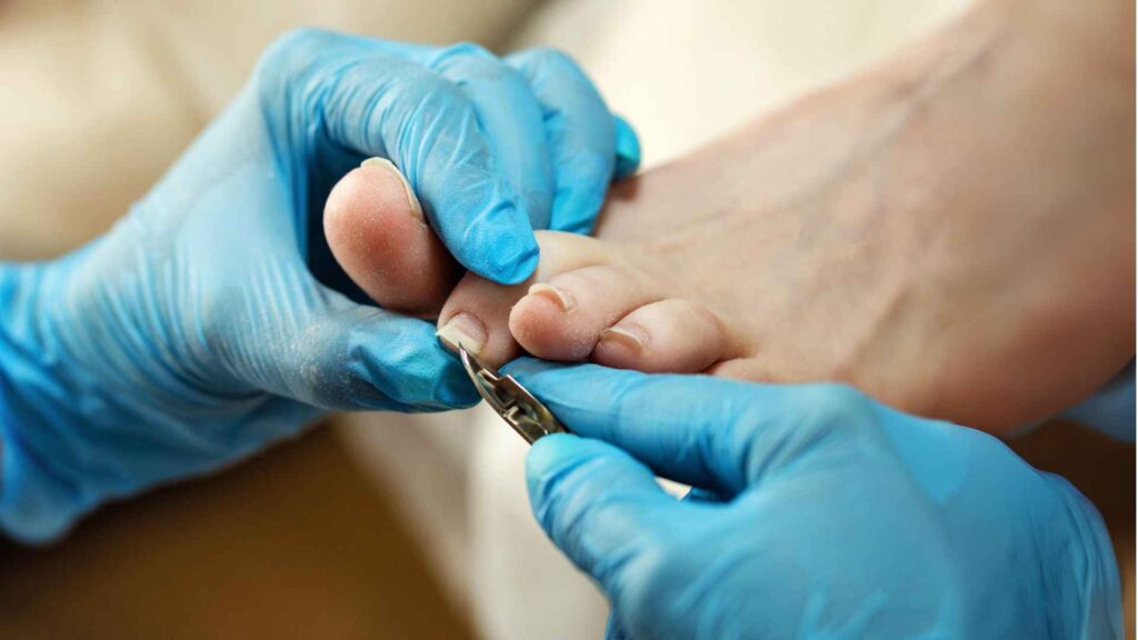 A podiatrist cutting diabetic foot nail